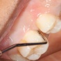 close-up of procedure. 