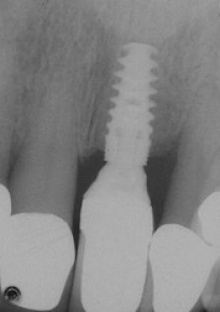 radiograph of implant. 