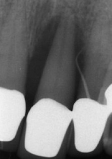 radiograph of tooth. 