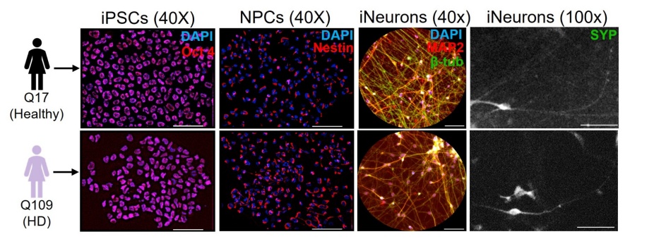 Zoom image: A comparison of healthy human neurons with neurons of a Huntington&rsquo;s disease patient where GSK3&szlig; and ERK1 were upregulated. Credit: Krzystek and Gunawardena/University at Buffalo 